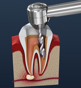 tooth nerve removal xray view