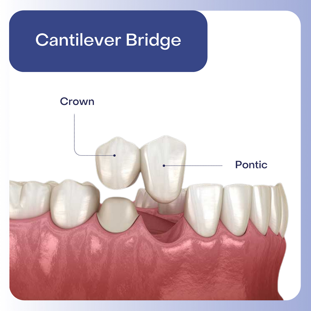 Cantilever Bridge Dental
