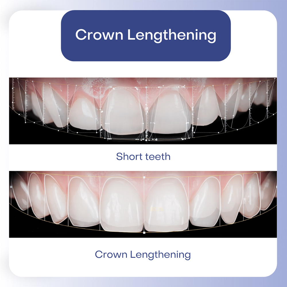Crown Lengthening for Dental Issues