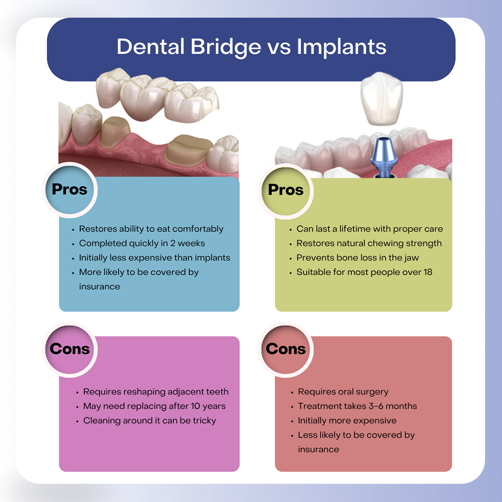 Dental Bridge vs Implants