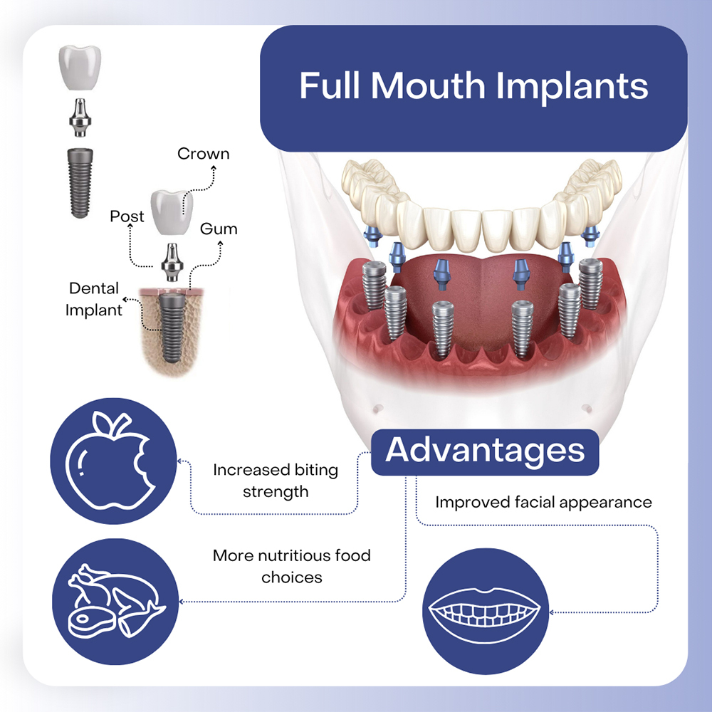 Same Day Dental Implants