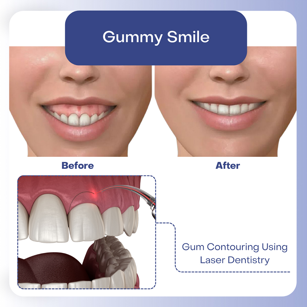 Gum Contouring Using Laser Dentistry