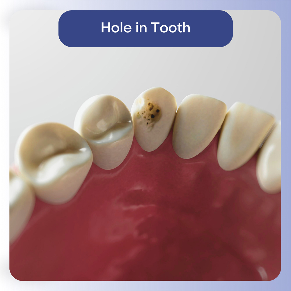 Hole in Tooth