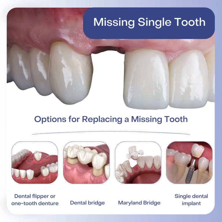 options-for-replacing-missing-single-tooth-hackensack-bergen-county-nj