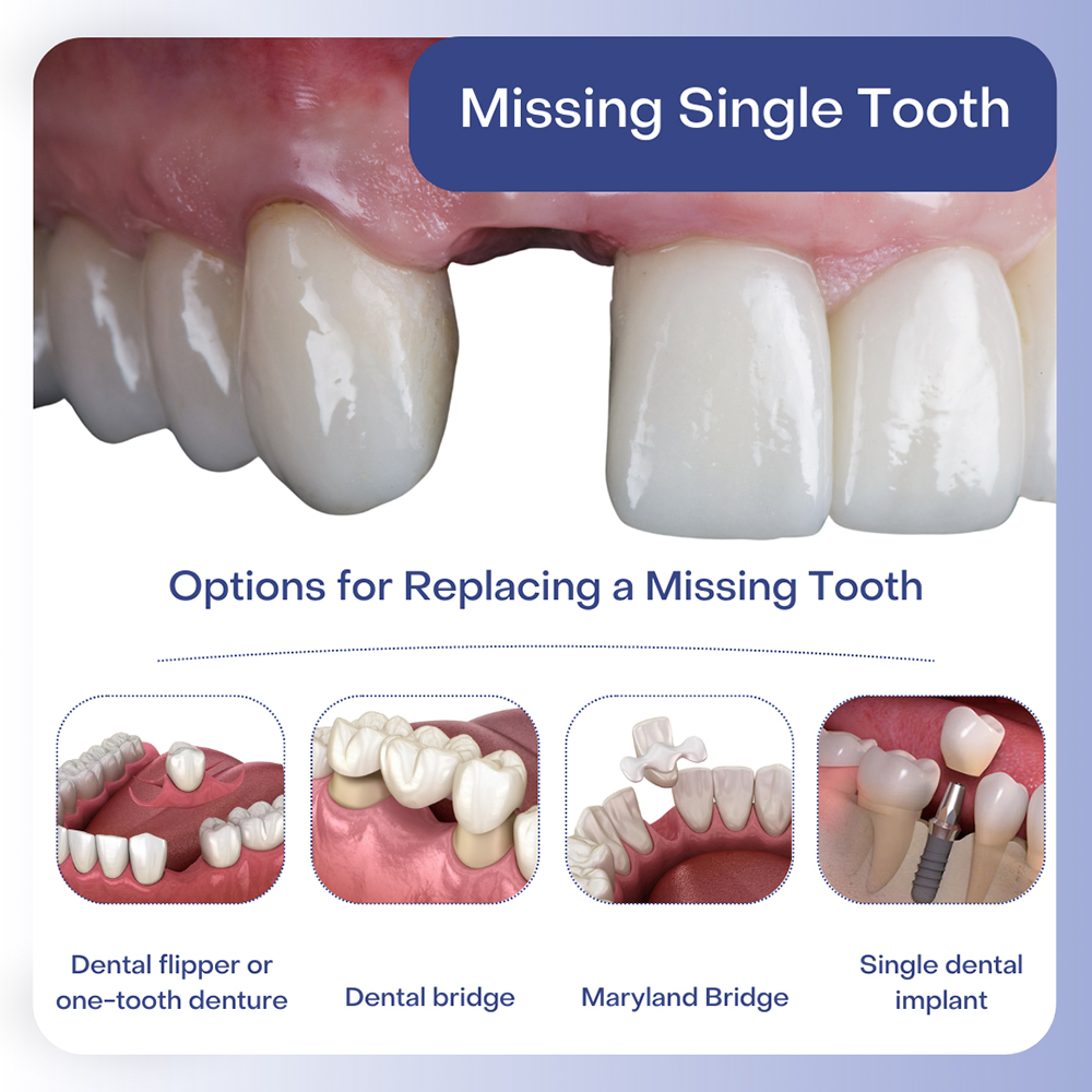 Options for Replacing a Missing Tooth