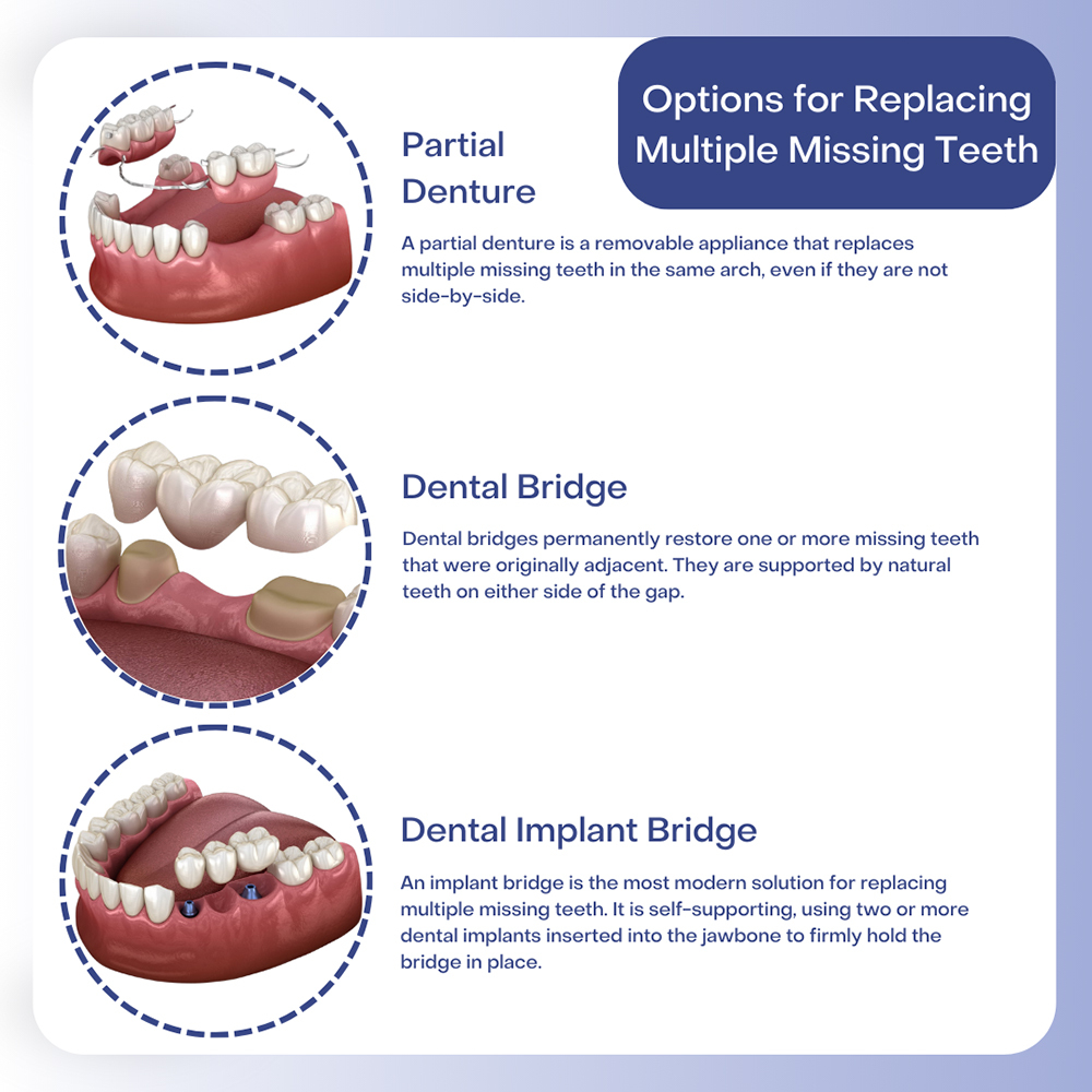 Options for Replacing Multiple Missing Teeth