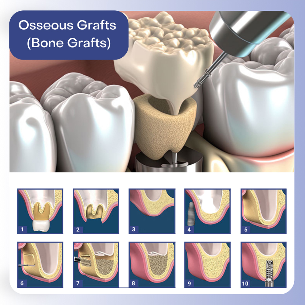 Osseous Grafts or Bone Grafts