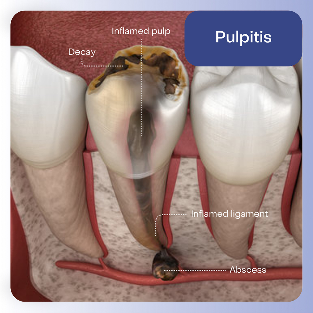 Pulpitis Treatment