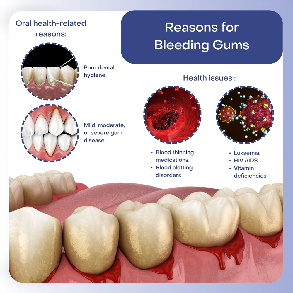 Reasons For Bleeding Gums