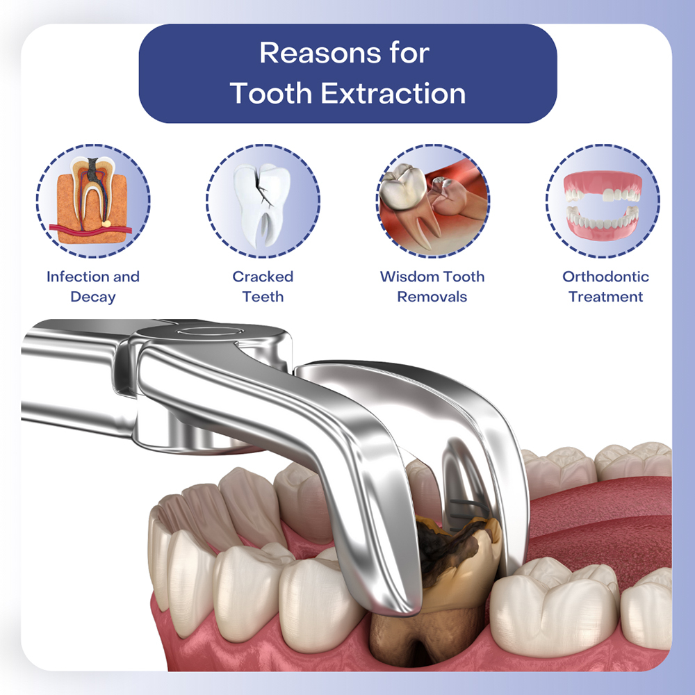 Reasons for Tooth Extraction