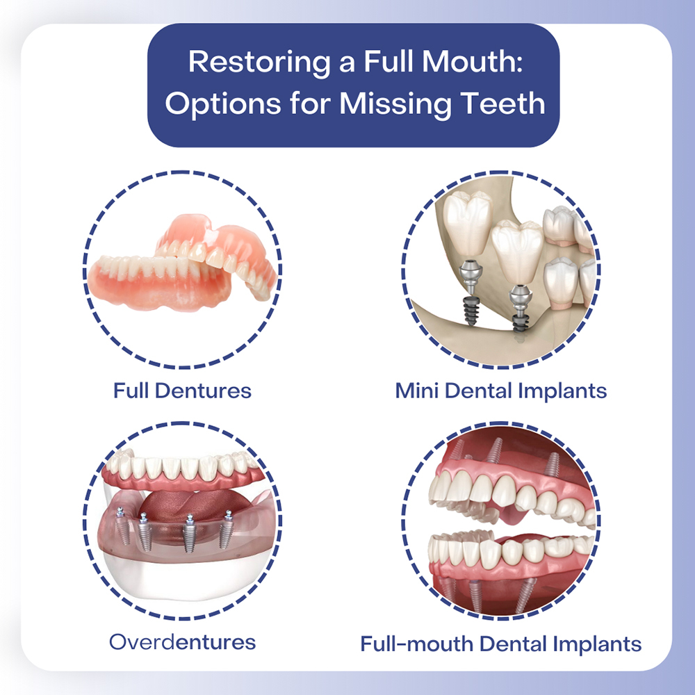 Restoring a Full Mouth Option for  Missing Teeth