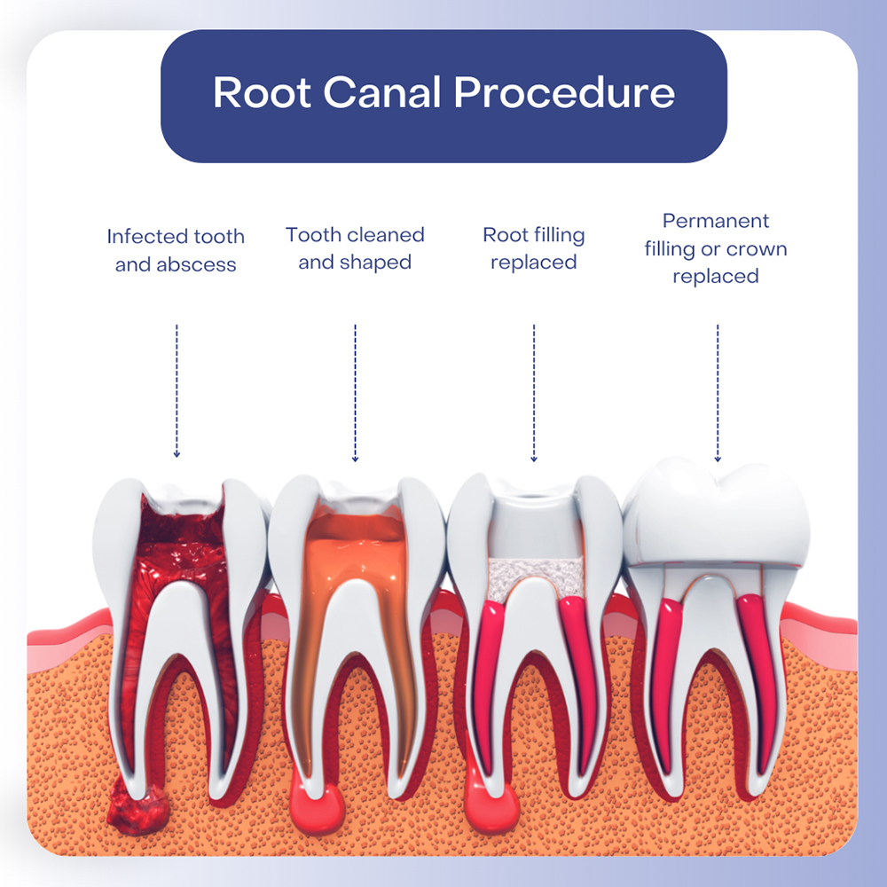 Root Canal Root Canal Molar Root Canals Endodontic Management Of The