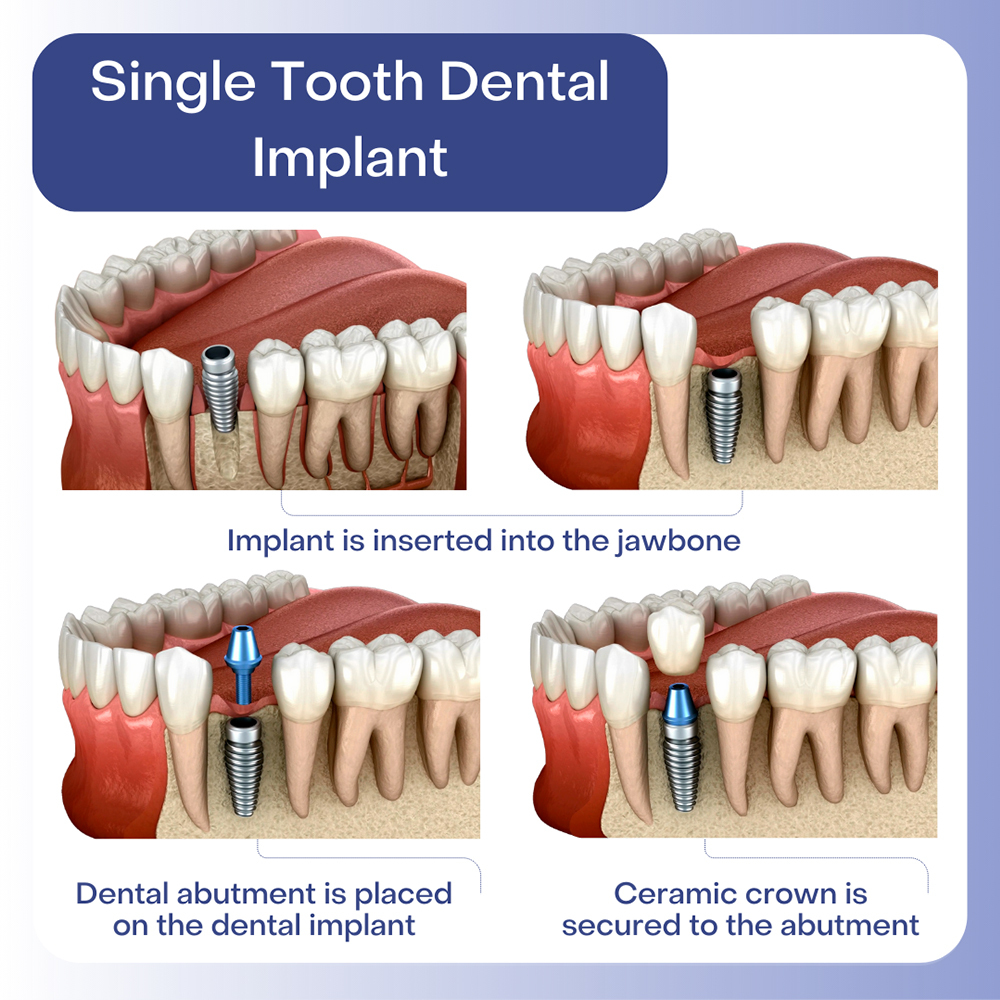 Same Day Dental Implants