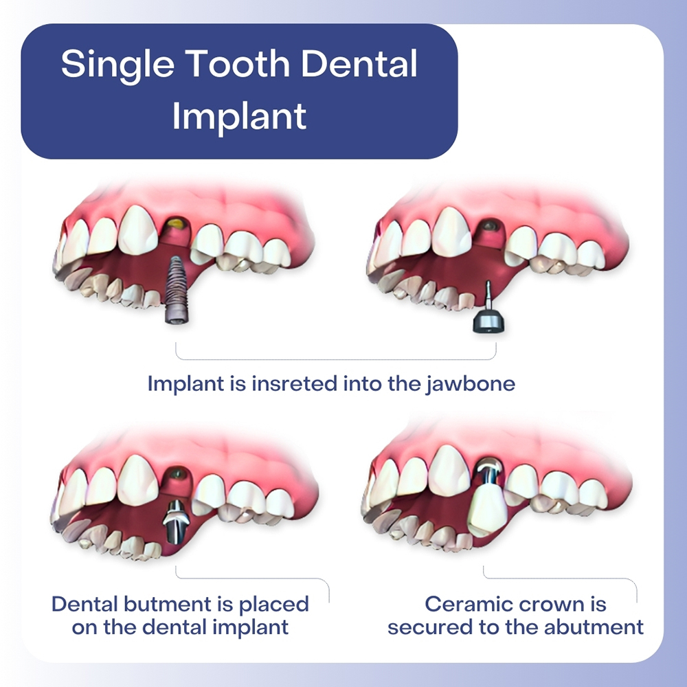 Single Tooth Implants Hackensack | Dental Implants in New Jersey