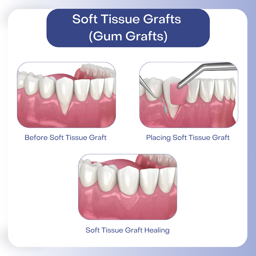 Soft Tissue Grafts or Gum Grafts