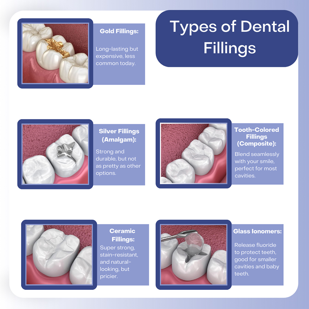 Types of Dental Fillings