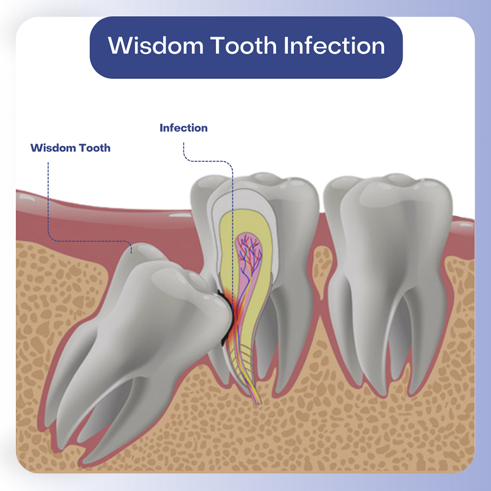Wisdom Tooth Infection
